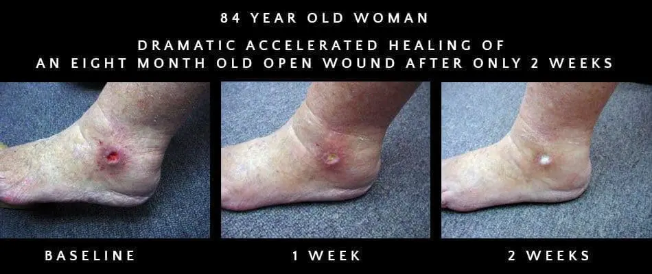 woundhealing