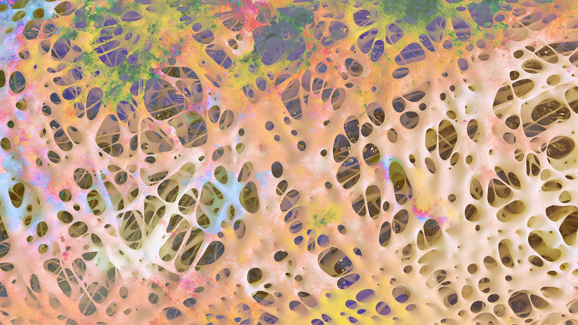 Osteoporosis advanced -high details - Stage 4 - 3d rendering